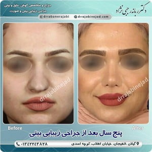 جراحی بینی