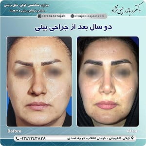 جراحی بینی گوشتی
