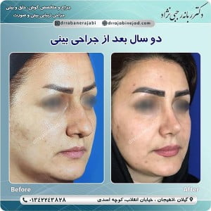 جراحی بینی گوشتی