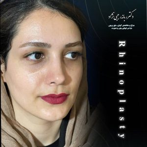 جراحی بینی گوشتی - دکتر رجبی نژاد 