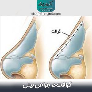 گرافت در جراحی بینی