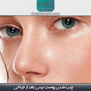 چرب شدن پوست بینی بعد از جراحی