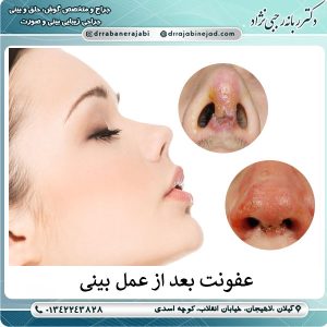 علائم و نشانه های عفونت بعد از عمل بینی