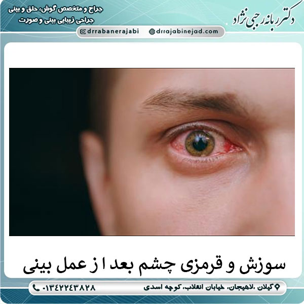 سوزش و قرمزی چشم بعد از عمل بینی