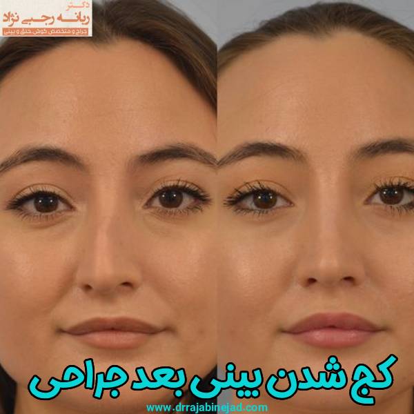 کج شدن بینی بعد عمل جراحی
