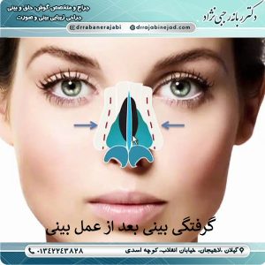 گرفتگی بینی بعد از عمل بینی