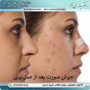 جوش صورت بعد از عمل بینی