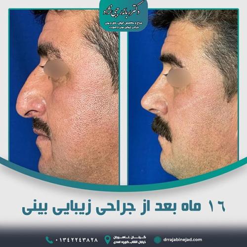 جراحی-بینی-در-لاهیجان-۱۳۸6