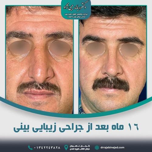 جراحی-بینی-در-لاهیجان-۱۳۸8