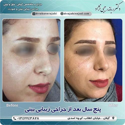 جراحی-بینی-68