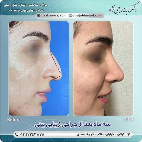 جراحی-بینی-لاهیجان-15