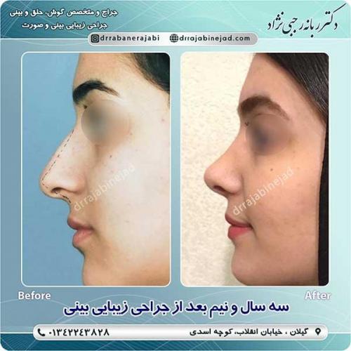 جراحی-بینی-لاهیجان-18