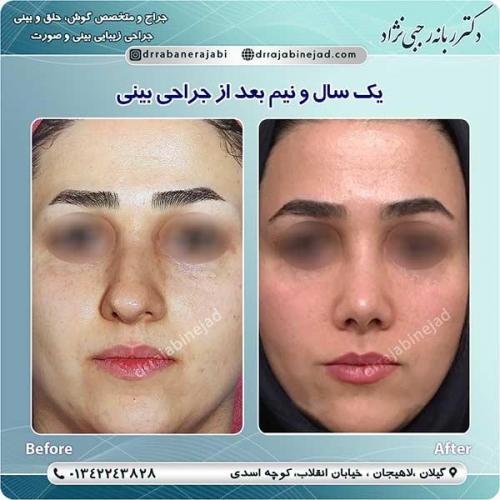 جراحی-بینی-لاهیجان-30