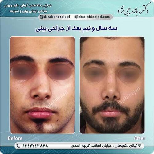 جراحی-بینی-لاهیجان-34