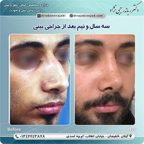 جراحی-بینی-لاهیجان-35