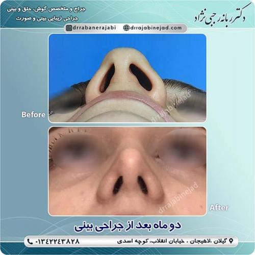 جراحی-بینی-لاهیجان-37