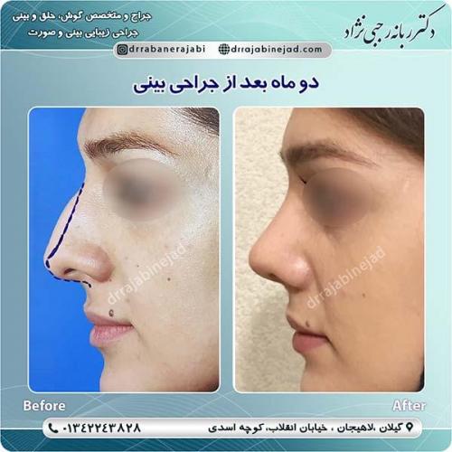 جراحی-بینی-لاهیجان-38