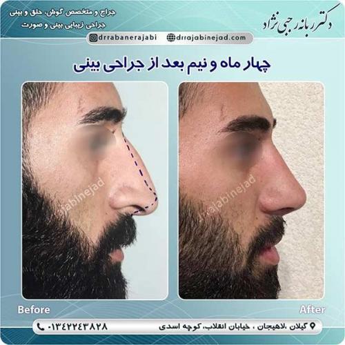جراحی-بینی-لاهیجان-40