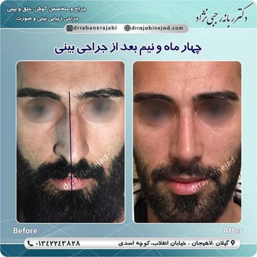 جراحی-بینی-لاهیجان-42