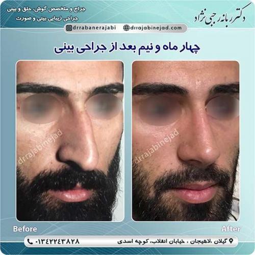 جراحی-بینی-لاهیجان-43