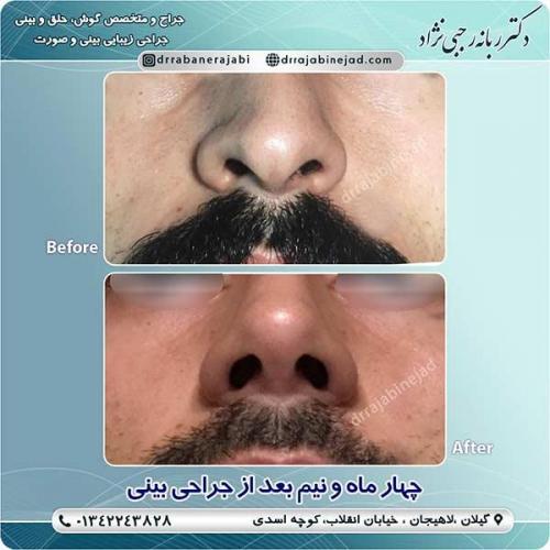 جراحی-بینی-لاهیجان-44
