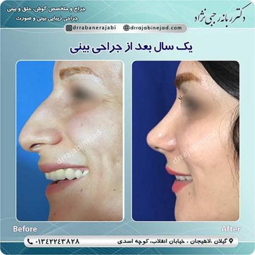 جراحی-بینی-لاهیجان-45