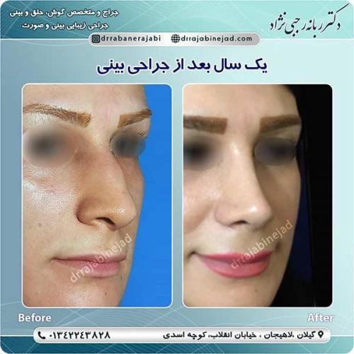 جراحی-بینی-لاهیجان-48