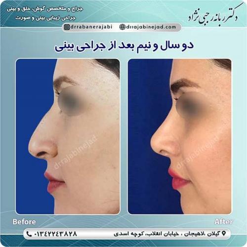 جراحی-بینی-لاهیجان-51