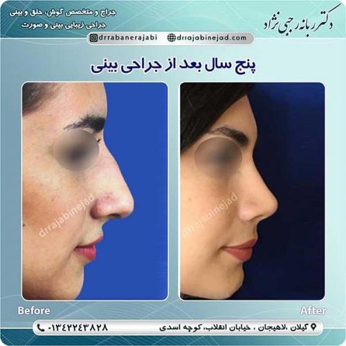 جراحی-بینی-لاهیجان-71