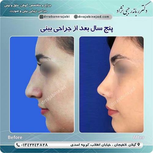 جراحی-بینی-لاهیجان-72