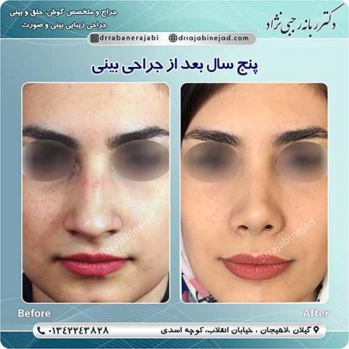 جراحی-بینی-لاهیجان-73