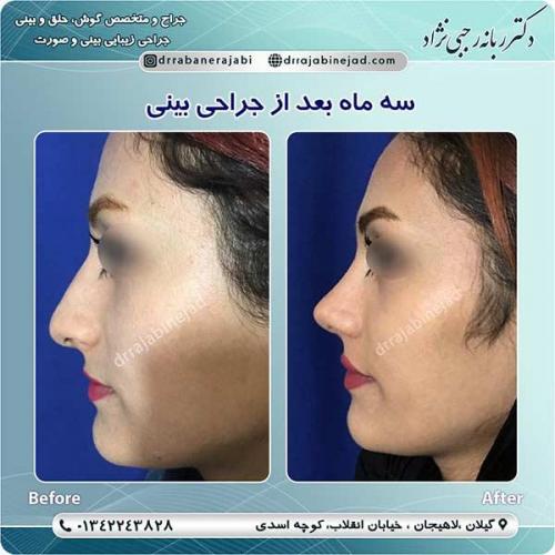 جراحی-بینی-لاهیجان-94