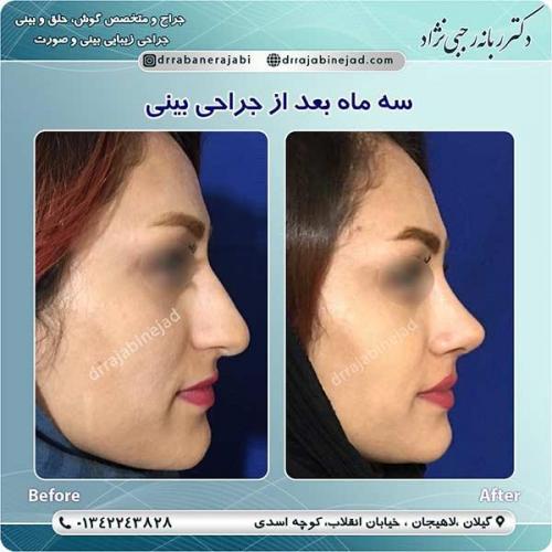 جراحی-بینی-لاهیجان-95