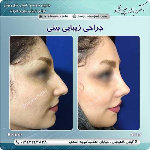 جراحی-بینی-لاهیجان-99
