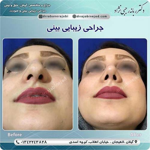 جراحی-بینی-لاهیجان-102