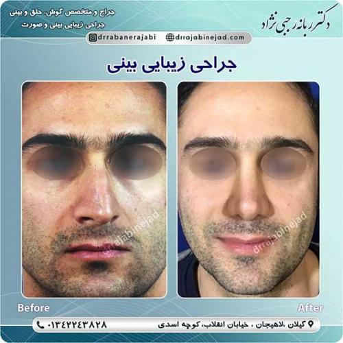 جراحی-بینی-لاهیجان-103