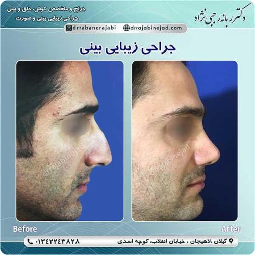 جراحی-بینی-لاهیجان-104