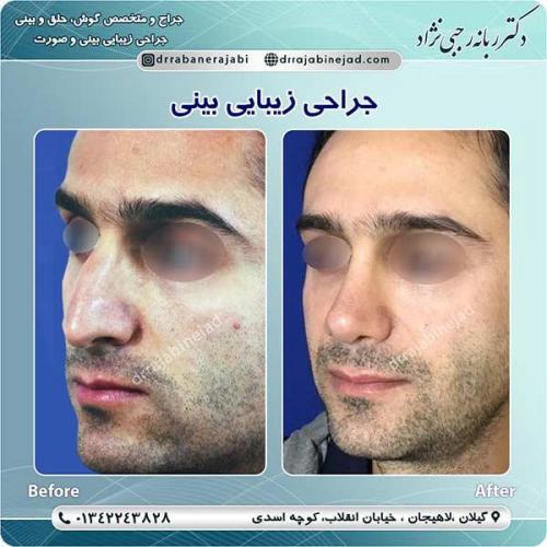 جراحی-بینی-لاهیجان-105