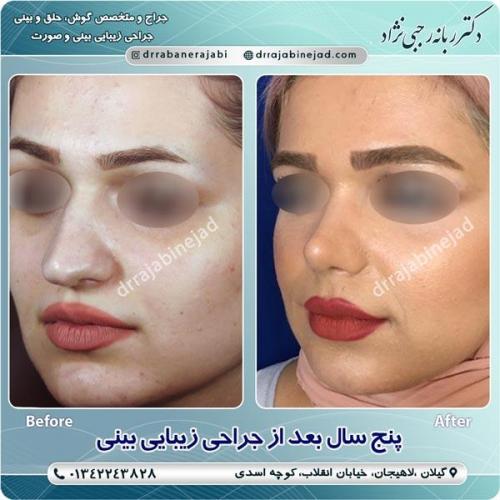 جراحی بینی 24
