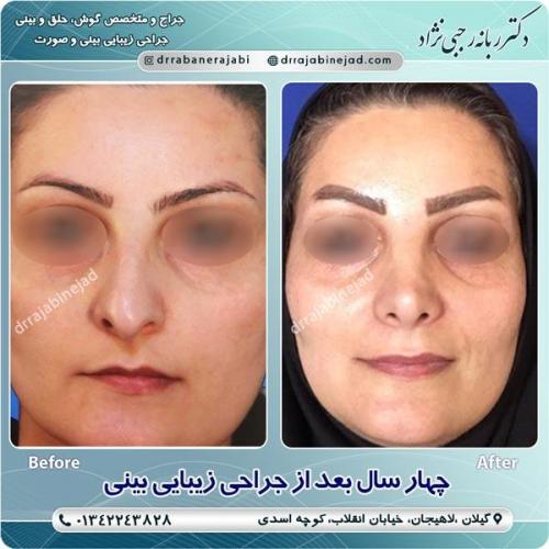 جراحی بینی 26