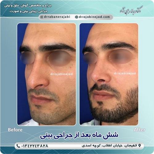 جراحی بینی 8
